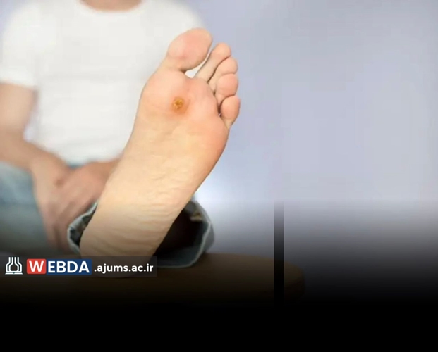 بی‌دردی زخم در افراد دیابتی نشانه خطر و پیشرفت آسیب عصبی است